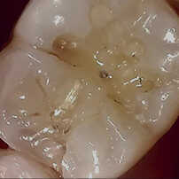  治療前の歯を口腔カメラで撮影した写真