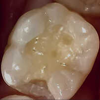  治療中の歯を口腔カメラで撮影した写真