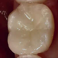  治療後の歯を口腔カメラで撮影した写真